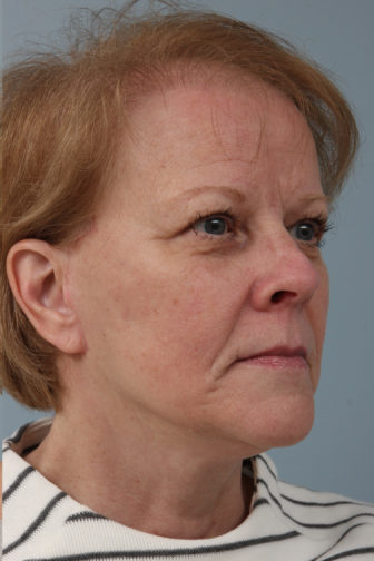 Closeup of elderly female showing tightening of her neck skin after weekend facelift procedure