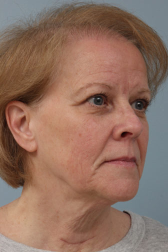 Closeup of elderly female showing excess facial wrinkles before weekend facelift procedure