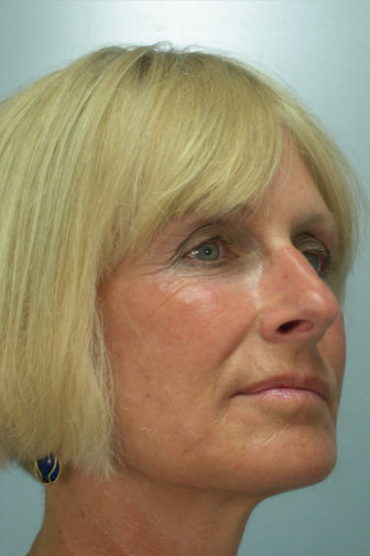 Closeup of female side profile showing tighten skin around her jowls and under eyes after weekend facelift surgery