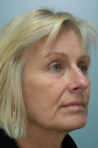 Closeup of female side profile showing loose skin in her jowls, under eyes, before weekend facelift surgery