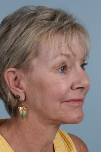 Closeup of an elderly female with tighter jowl and neck skin and less wrinkles on her face after a weekend facelift