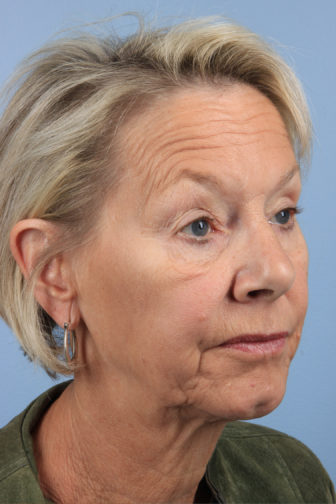 Closeup of elderly female wearing a green jacket showing loose, wrinkled jowl and neck skin before weekend facelift