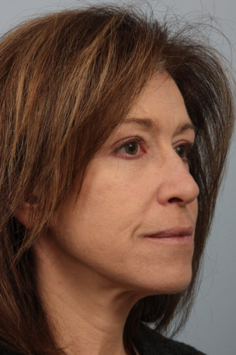 Closeup of a female wearing a black shirt showing firm and smooth face and neck skin after having a weekend neck lift surgery