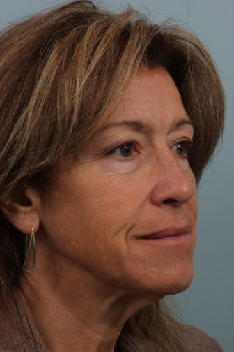 Closeup photo of a female showing loose skin on her neck and wrinkles before weekend facelift procedure