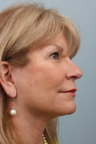 Closeup of blonde female wearing earrings, showing firm skin in her midface and neck after weekend neck lift surgery