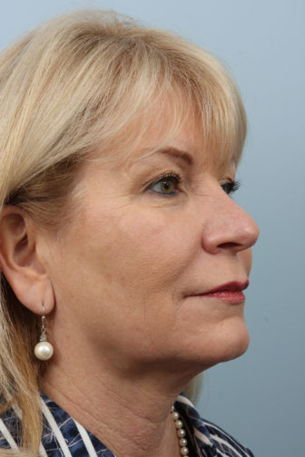 Closeup of blonde female wearing a blue striped shirt, showing sagginess of skin in her midface and neck before weekend neck lift surgery