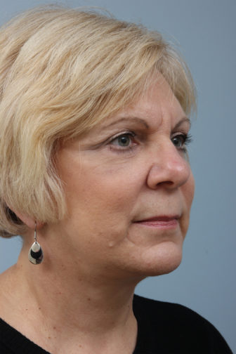 Closeup of blonde female showing firmer skin on her under eyes, neck, and jawline after a weekend facelift procedure