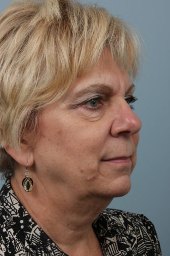 Closeup of a blonde female showing sagging skin and visible wrinkles on her face and neck before a weekend facelift