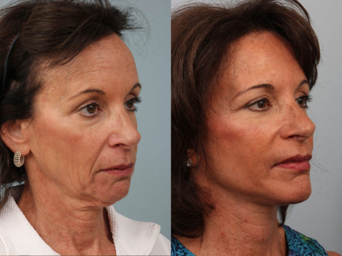 FL-01 before and after | Albany, Latham, Saratoga NY, Plastic Surgery