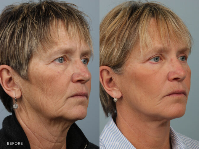 Side by side before and after of a woman with short blonde hair who had a facelift procedure in Albany, NY. Excess skin and fat around her neck has been removed and she looks years younger.| Albany, Latham, Saratoga NY, Plastic Surgery