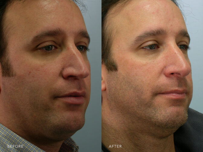 Side by side before and after of a man who had cosmetic nose surgery (rhinoplasty) in Albany, NY. The tip of his nose is no longer pinched and his bridge is straighter. | Albany, Latham, Saratoga NY, Plastic Surgery