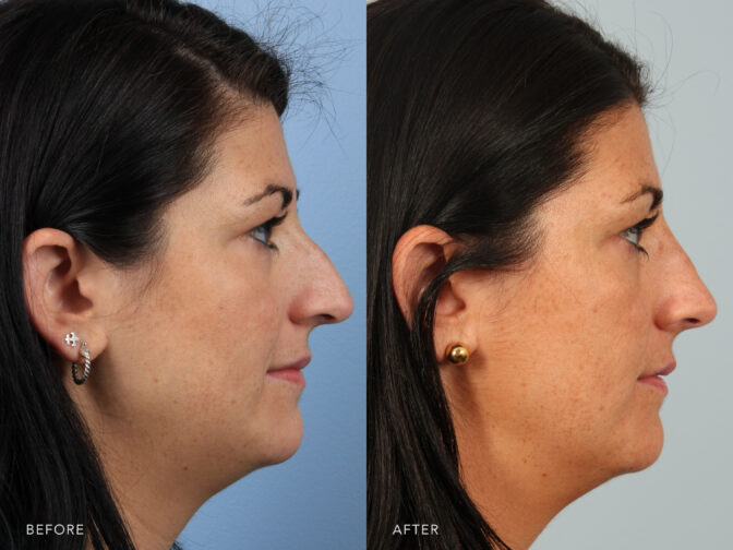 Side by side before and after of a middle aged woman who got a rhinoplasty in Albany, NY. Her nasal hump was removed and her nose is smaller and straighter. | Albany, Latham, Saratoga NY, Plastic Surgery