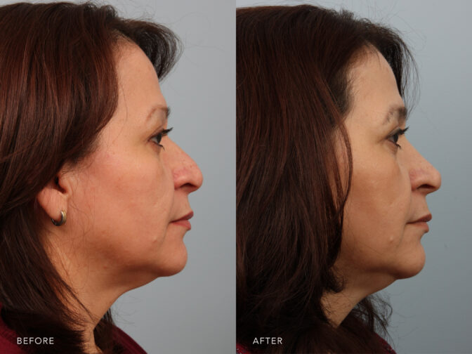 Side by side before and after of a woman who had rhinoplasty surgery in Albany, NY. Her nasal hump was removed and her nose is smaller and straighter. | Albany, Latham, Saratoga NY, Plastic Surgery