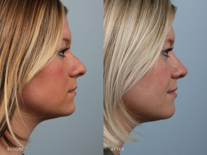 Side by side before and after of a blonde adult woman who had a rhinoplasty in Albany, NY. Her nose is smaller and straighter, her nasal hump was removed. | Albany, Latham, Saratoga NY, Plastic Surgery