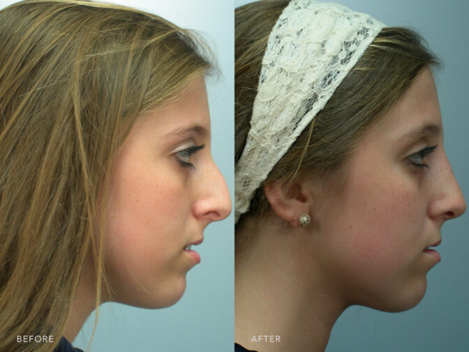 Side by side before and after of a teenage girl who had rhinoplasty surgery in Albany, NY. Her nasal hump was removed and her nose is smaller and straight. | Albany, Latham, Saratoga NY, Plastic Surgery