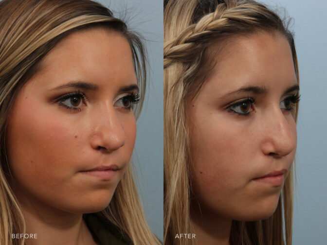 This is a before and after of a young girl who had a revision rhinoplasty to address her nose being unsymmetrical. The tip of her nose looks less caved in and more full. | Albany, Latham, Saratoga NY, Plastic Surgery