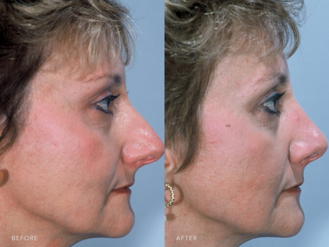 Side by side before and after of a woman who had a rhinoplasty surgery in Albany, NY. The bridge of her nose is smaller and straighter resulting in a more feminine nose. | Albany, Latham, Saratoga NY, Plastic Surgery