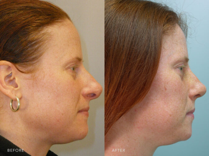 Side by side before and after of a woman who had rhinoplasty surgery in Albany, NY. The bridge of her nose was taken down and she now has a smaller more feminine nose. | Albany, Latham, Saratoga NY, Plastic Surgery
