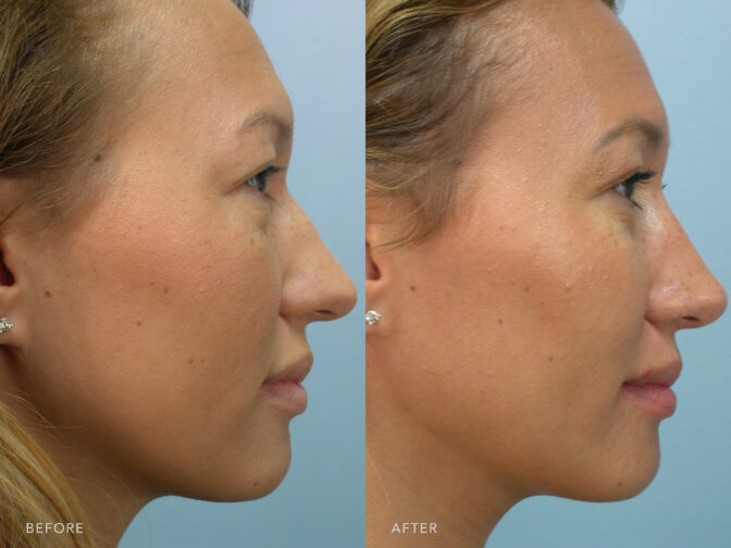 Side by side before and after of a woman who had a rhinoplasty done in Albany, NY. Her nasal hump has been taken down leaving her with a smaller more feminine looking nose. | Albany, Latham, Saratoga NY, Plastic Surgery