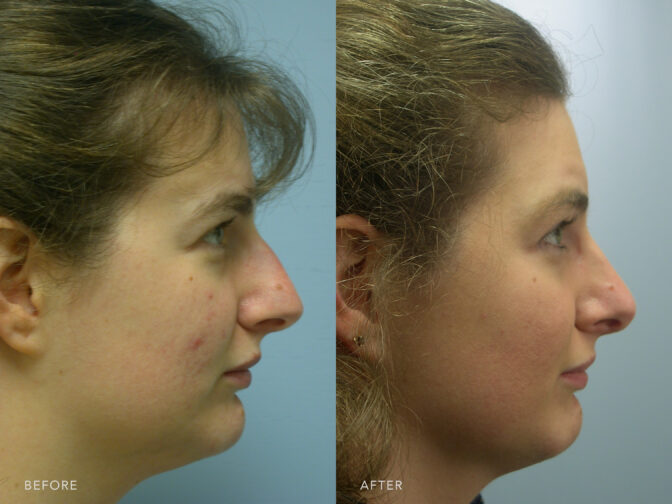 Side by side before and after of a woman who had a rhinoplasty surgery in albany, NY. Her nasal hump was removed and her nose is now smaller and straighter. | Albany, Latham, Saratoga NY, Plastic Surgery