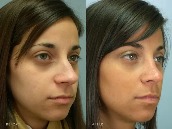 Side by side before and after of a woman who had a rhinoplasty in Albany, NY. Her nose is smaller, straighter, and more feminine. | Albany, Latham, Saratoga NY, Plastic Surgery