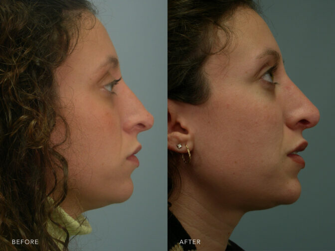 Side by side before and after of a woman who had a rhinoplasty to address the tip of her nose. Her tip is fuller resulting in a straighter bridge appearance. | Albany, Latham, Saratoga NY, Plastic Surgery