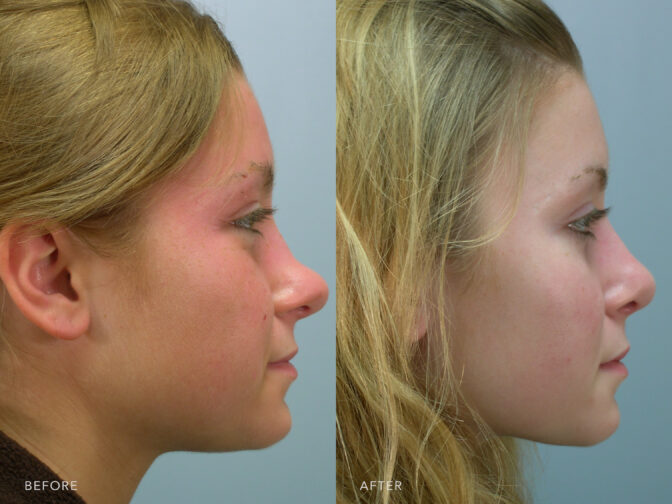 Side by side before and after of a blonde woman who had a rhinoplasty in Albany, NY. Her tip used to be titled up and was very defined, now it is smaller and filled for a seamless appearance. | Albany, Latham, Saratoga NY, Plastic Surgery