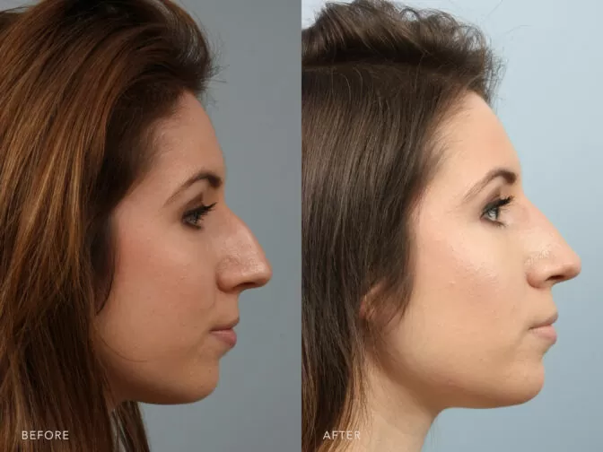 Side by side before and after of a young woman who had rhinoplasty surgery in Albany, NY. Her nasal hump has been removed and her nose is smaller and straighter. | Albany, Latham, Saratoga NY, Plastic Surgery