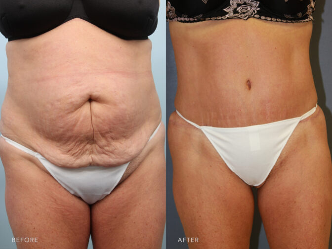Side by side before and after of a woman who had an abdominoplasty surgery. Before surgery she had excess skin and fat on her abdomen with a distended gut. After surgery the excess skin and fat were removed and the ab muscles were restored. | Albany, Latham, Saratoga NY, Plastic Surgery
