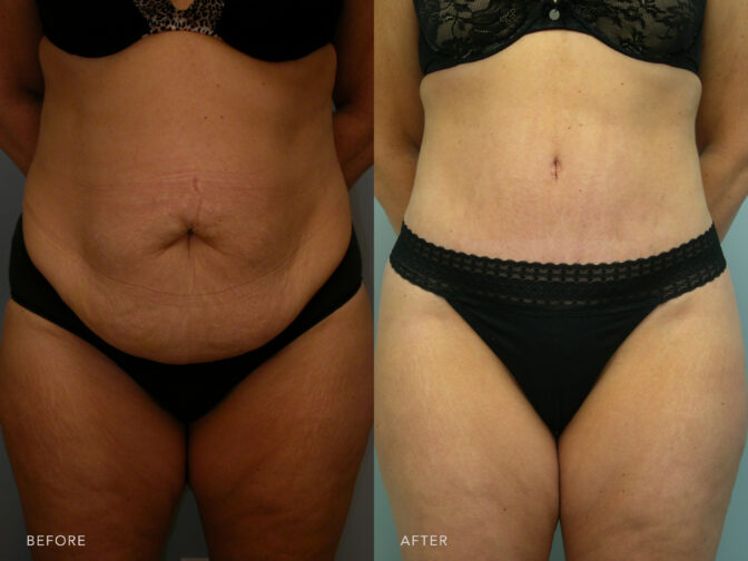 Side by side before and after of a woman's body from the neck down who had tummy tuck surgery. She had excess skin and fat in her abdomen that was removed leaving her with a flat and toned abdomen. | Albany, Latham, Saratoga NY, Plastic Surgery