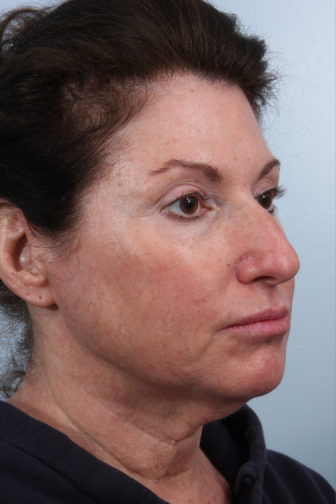 Closeup of a female wearing a black shirt showing flabby cheeks and neck skin before a deep plane facelift