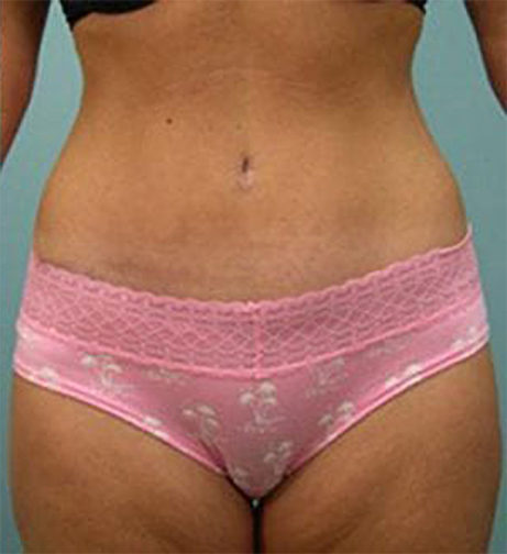 Closeup of female wearing pink and black spotted underwear, showing nicely shaped abdomen after tummy tuck surgery