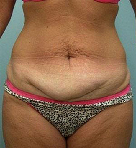 Closeup of female wearing pink and black showing excess fat along her lower body before a tummy tuck surgery