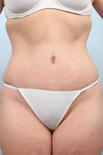 Closeup of a female after tummy tuck surgery wearing white underwear showing tighten abdominal muscles