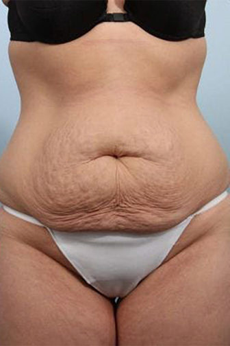 Closeup of a female before tummy tuck surgery wearing white underwear showing excess abdominal skin