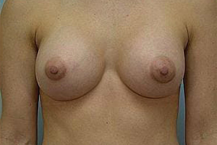 Closeup of a female with larger breasts after breast augmentation plastic surgery