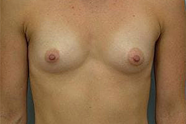 Closeup of a female showing a flat chest before having breast augmentation plastic surgery