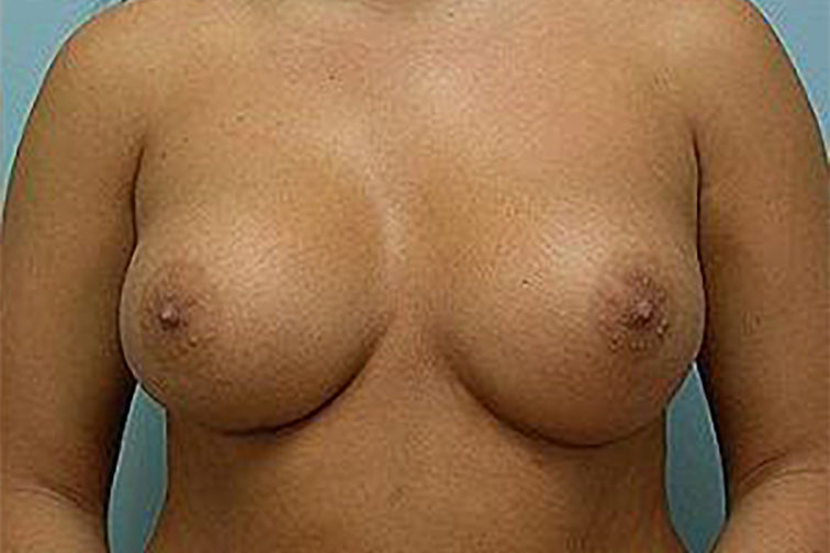 Closeup of a female body showing larger breasts after undergoing breast augmentation plastic surgery