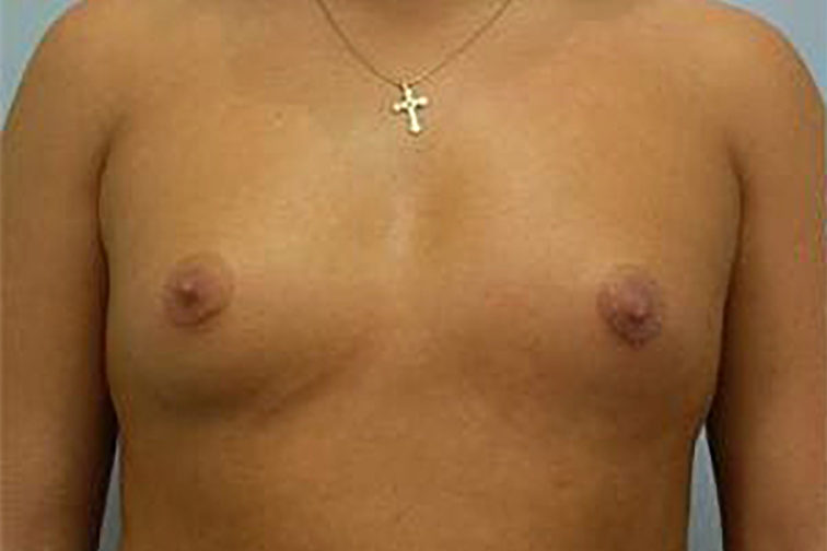 Closeup of a female's body showing small breasts before breast augmentation surgery