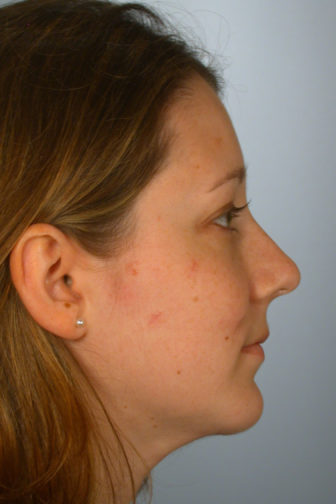 Closeup of a brunette female showing a smoother shape of her nose after undergoing a rhinoplasty plastic surgery