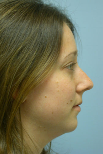 Closeup of a female with brown hair showing curved nasal tip before undergoing a rhinoplasty plastic surgery