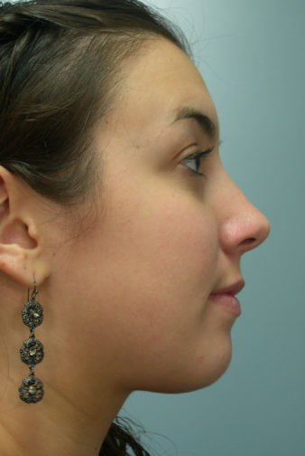 Closeup of a female with brown hair wearing black earrings showing straight, symmetrical feminine nose after rhinoplasty