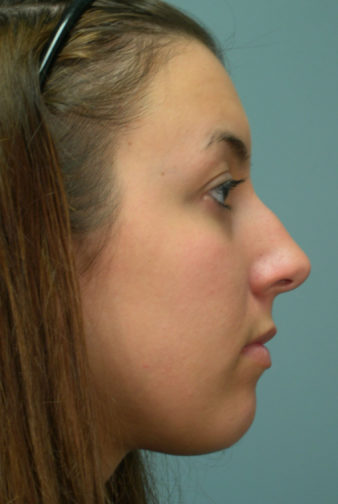 Closeup of a brunette showing masculine nose and distorted shape of her nose before rhinoplasty plastic surgery