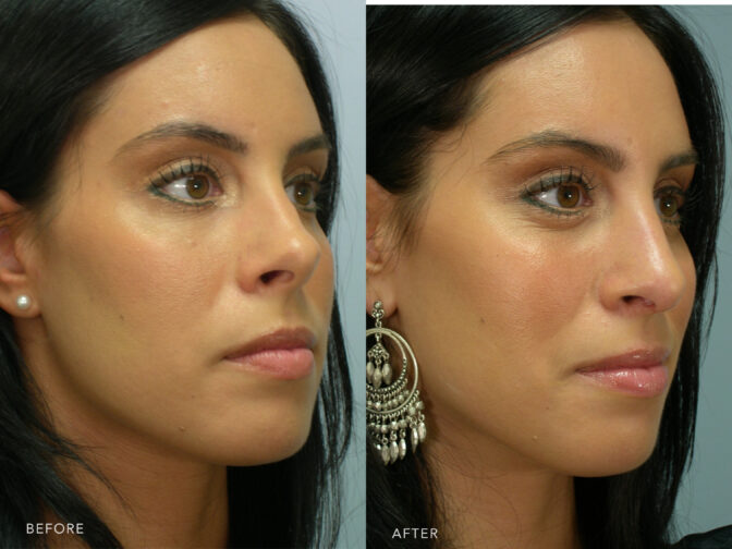 Before and after of a young woman who had nose surgery (rhinoplasty) in Albany, NY. The tip of her nose was fixed from an upward tilt to normal. | Albany, Latham, Saratoga NY, Plastic Surgery