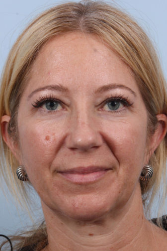 Close-up of a blonde female wearing silver earrings showing tighter upper eyelid skin after a blepharoplasty procedure
