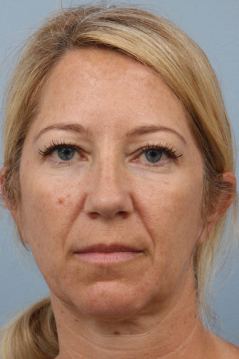 Close-up of a female with golden blonde hair showing heaviness in her upper lid before a sliver blepharoplasty procedure