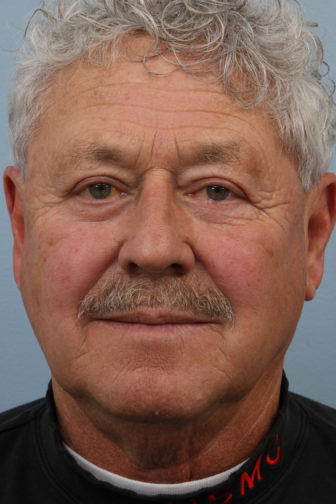 Close-up of a male with a black shirt showing tight skin on his upper eyelid and under-eyes after blepharoplasty surgery