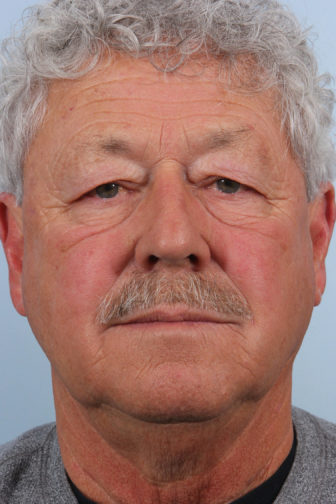 Close-up of a male wearing a gray shirt showing loose upper eyelid skin covering his eyes before blepharoplasty surgery