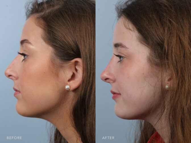 Side by side before and after of a young woman who had a rhinoplasty done in Albany, NY. Her nasal bridge was taken down to give her a feminine button looking nose. | Albany, Latham, Saratoga NY, Plastic Surgery