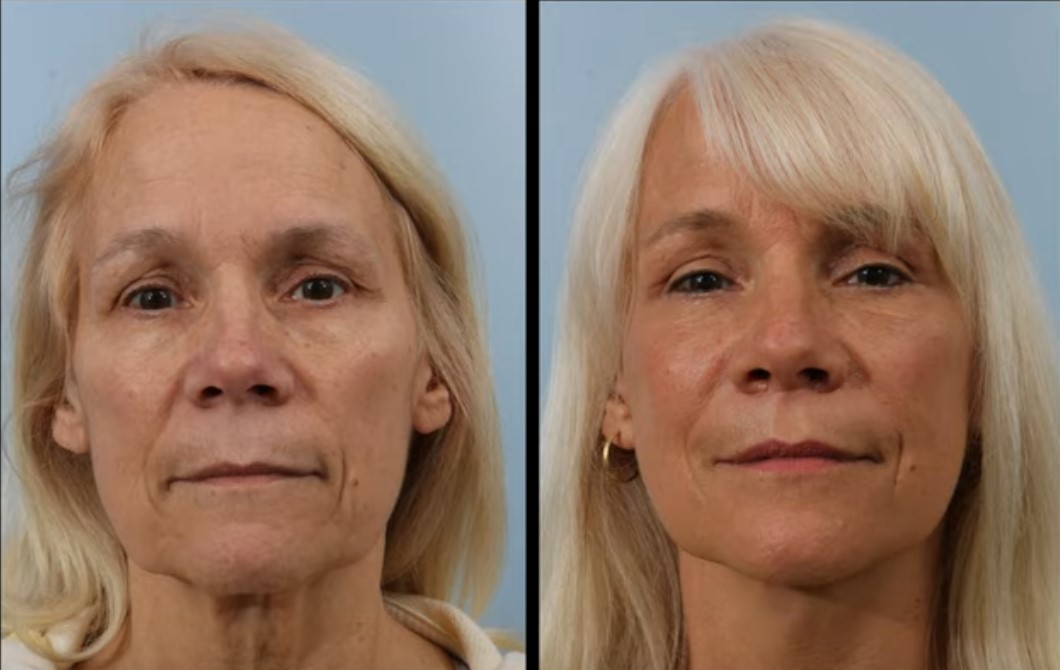 Make Lips Wider Surgery